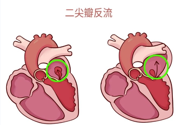 体检报告里的心脏瓣膜反流，你读懂了吗？